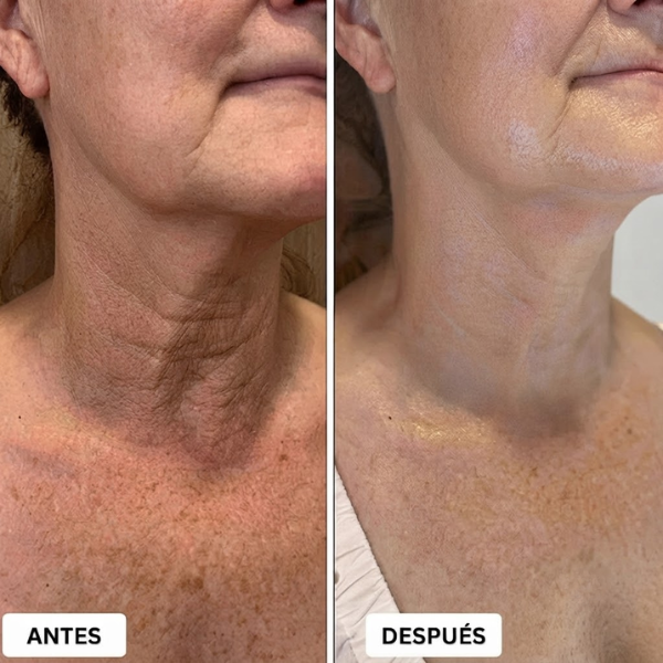 Aureva™ Dispositivo de Lifting Facial