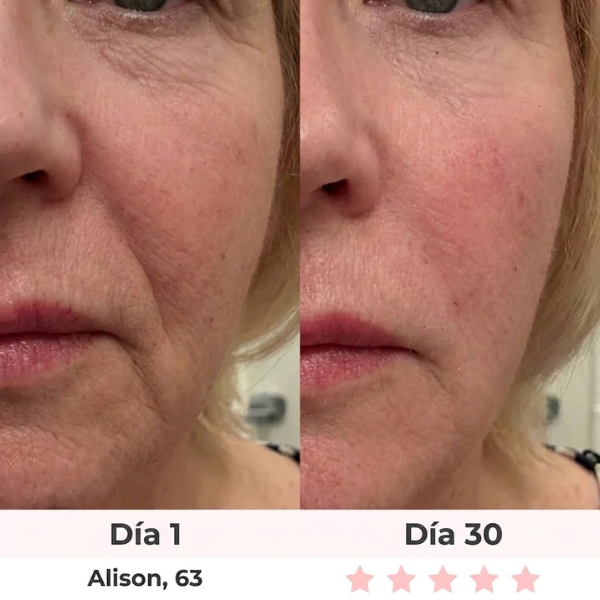 Aureva Dispositivo de Lifting Facial / 2